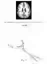 Fig. 13 - Swallowing air pulse therapy mouthpiece and method for the use thereof