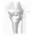 Fig. 01 - Deployable joint infection treatment system