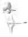 Fig. 07 - Deployable joint infection treatment system