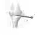 Fig. 11 - Deployable joint infection treatment system