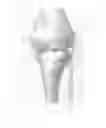 Fig. 12 - Deployable joint infection treatment system