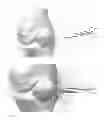 Fig. 15 - Deployable joint infection treatment system