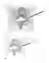 Fig. 18 - Deployable joint infection treatment system