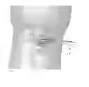 Fig. 20 - Deployable joint infection treatment system