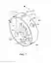 Fig. 07 - Catheter deflection anchor