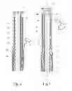 Fig. 04 - Catheter activation by handle removal