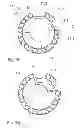 Fig. 04 - Ophthalmologic laser device and method for preventing and treating aftercataract