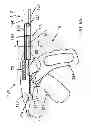 Fig. 06 - ELECTROSURGICAL END EFFECTOR WITH INDEPENDENT CLOSURE FEATURE AND BLADE