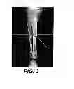 Fig. 03 - Orthopedic fastener device