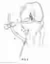 Fig. 06 - System for ACL reconstruction using retrograde cutter