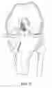 Fig. 07 - System for ACL reconstruction using retrograde cutter