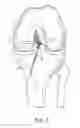 Fig. 09 - System for ACL reconstruction using retrograde cutter