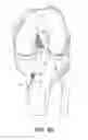 Fig. 13 - System for ACL reconstruction using retrograde cutter