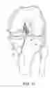 Fig. 14 - System for ACL reconstruction using retrograde cutter