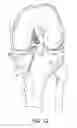 Fig. 16 - System for ACL reconstruction using retrograde cutter