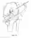 Fig. 17 - System for ACL reconstruction using retrograde cutter