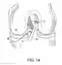 Fig. 18 - System for ACL reconstruction using retrograde cutter