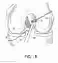 Fig. 19 - System for ACL reconstruction using retrograde cutter