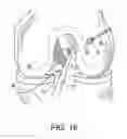Fig. 20 - System for ACL reconstruction using retrograde cutter