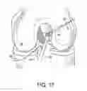 Fig. 21 - System for ACL reconstruction using retrograde cutter