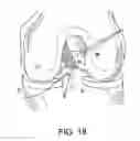 Fig. 22 - System for ACL reconstruction using retrograde cutter