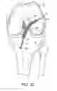 Fig. 24 - System for ACL reconstruction using retrograde cutter