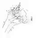 Fig. 02 - Distal resection systems and methods