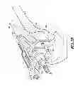 Fig. 05 - Distal resection systems and methods
