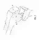 Fig. 08 - Distal resection systems and methods