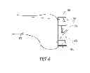 Fig. 10 - Distal resection systems and methods
