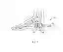 Fig. 06 - Catheter with integrated cement delivery balloon