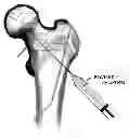Fig. 01 - Device, Composition and Method for Prevention of Bone Fracture and Pain