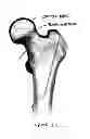 Fig. 02 - Device, Composition and Method for Prevention of Bone Fracture and Pain