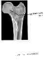 Fig. 03 - Device, Composition and Method for Prevention of Bone Fracture and Pain