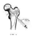 Fig. 04 - Device, Composition and Method for Prevention of Bone Fracture and Pain