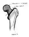 Fig. 08 - Device, Composition and Method for Prevention of Bone Fracture and Pain