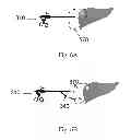 Fig. 10 - Device and method for assisting laparoscopic surgery—rule based approach