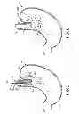 Fig. 04 - ASSEMBLIES FOR DEPLOYING FASTENERS IN TISSUE AND SNARES FOR USE IN SUCH ASSEMBLIES