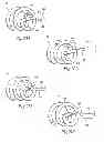 Fig. 24 - Systems and methods for attaching a prosthesis within a body lumen or hollow organ