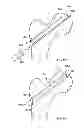 Fig. 45 - Fixation systems and methods