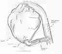 Fig. 01 - Method and apparatus for effecting a minimally invasive distal anastomosis for an aortic valve bypass
