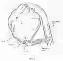 Fig. 02 - Method and apparatus for effecting a minimally invasive distal anastomosis for an aortic valve bypass