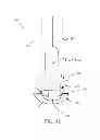 Fig. 13 - Method and apparatus for effecting a minimally invasive distal anastomosis for an aortic valve bypass