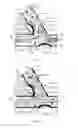 Fig. 14 - Vessel shaping devices and methods