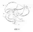 Fig. 02 - Intragastric device for treating obesity
