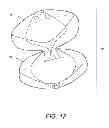 Fig. 19 - Intragastric device for treating obesity