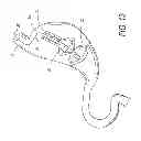 Fig. 20 - Intragastric device for treating obesity