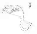 Fig. 23 - Intragastric device for treating obesity