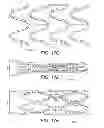 Fig. 25 - Intragastric device for treating obesity