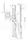 Fig. 03 - RAPID EXCHANGE TEMPORARY BLOOD FLOW CESSATION DEVICE FOR LARGE BORE CLOSURE